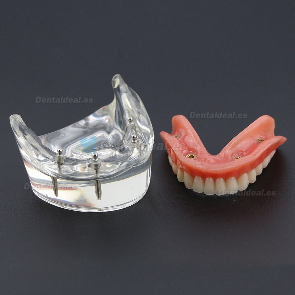 Dientes inferiores dental Modelo de sobredentadura 4 implantes Demostración Modelo 6002 02